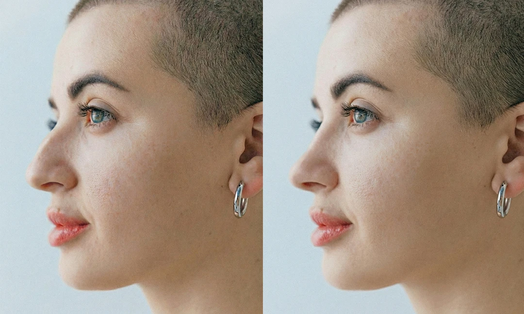 ¿Qué es la Rinoplastia Ultrasónica? La Revolución de la Precisión en Cirugía Nasal. 